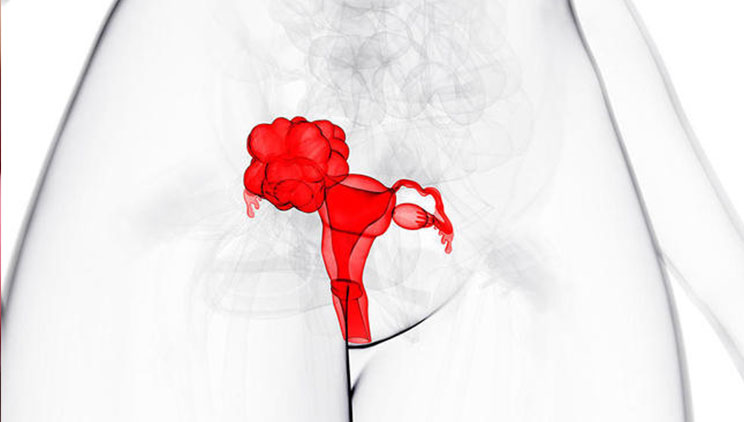 endometriozas