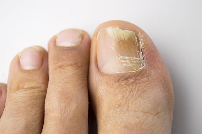 onychomycosis with fungal nail infection