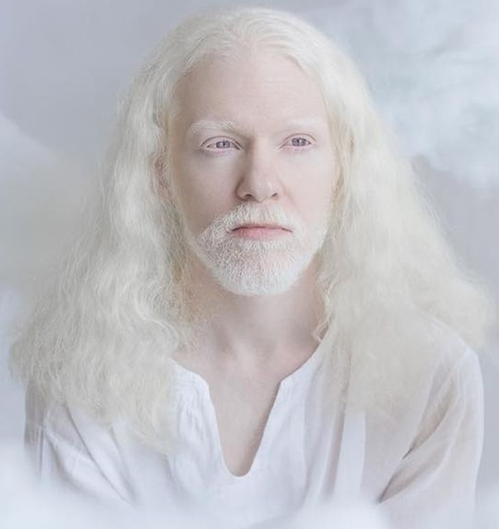 albinizmi (1)