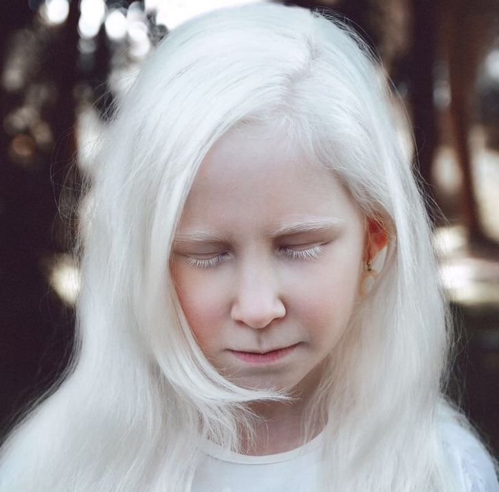 albinizmi (10)