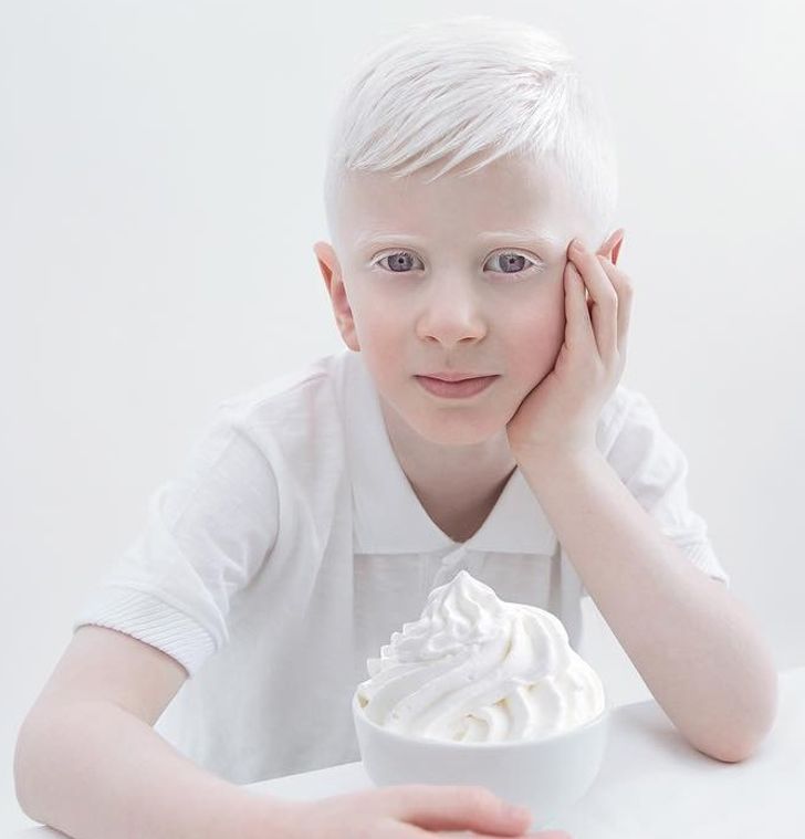 albinizmi (12)