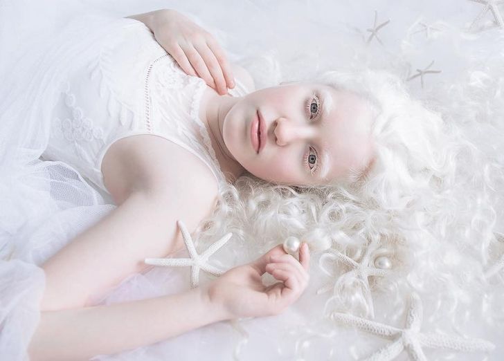 albinizmi (18)