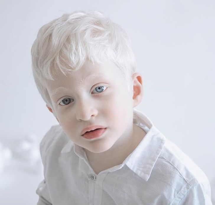 albinizmi (19)