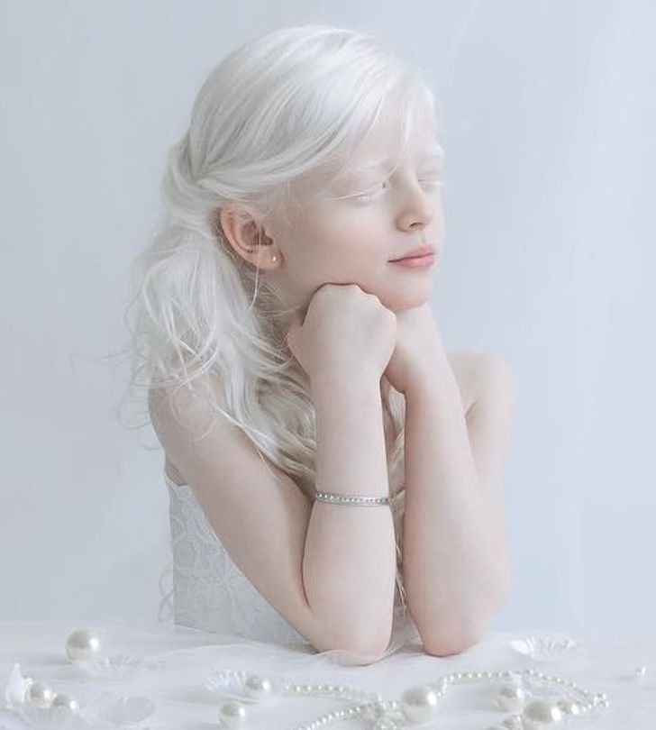 albinizmi (3)