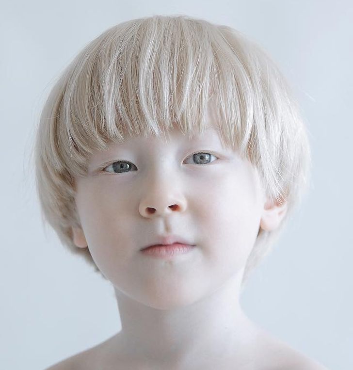 albinizmi (4)