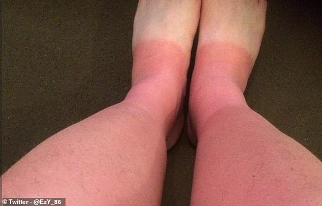 15472514-7199985-_BringonWinter_This_Twitter_user_suffered_burnt_ankles_after_che-a-1_1561976487831