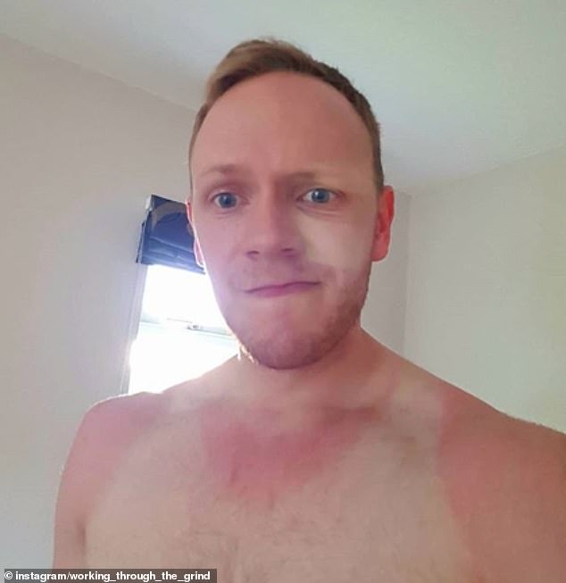 15476390-7199985-One_man_from_Congleton_in_Cheshire_said_he_d_suffered_this_sunbu-a-99_1561978130269