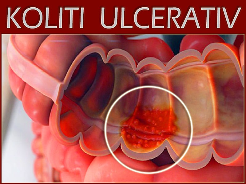 koliti_ulcerativ