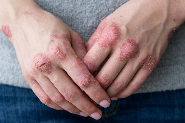 psoriaya